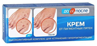 До и после крем от пигментации 50мл